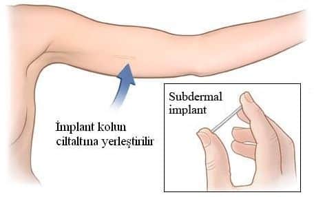 deri altı implant