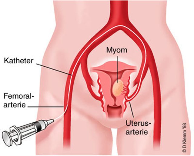 MİYOM - uterin arter embolizasyonu